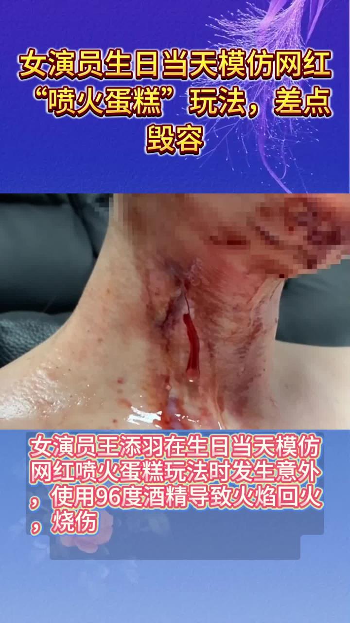 女演员生日当天模仿网红“喷火蛋糕”玩法,差点毁容