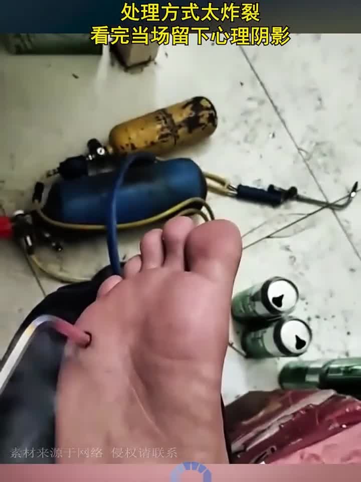 男子脚上长鸡眼,处理方式太炸裂,看完当场留下心理阴影!