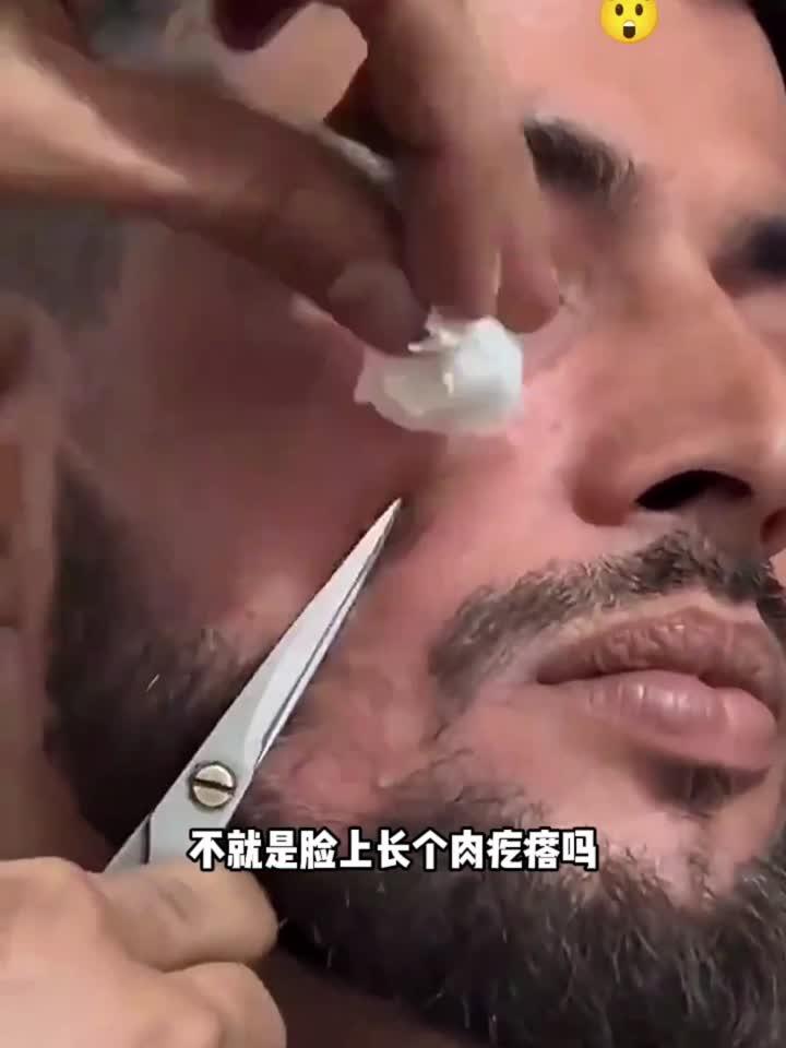 用剪刀剪肉疙瘩,看着都疼
