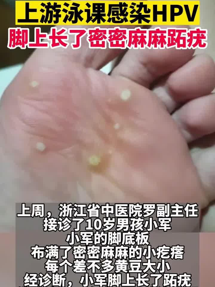 游泳后男孩脚上长满跖疣,警惕HPV病毒在泳池传播