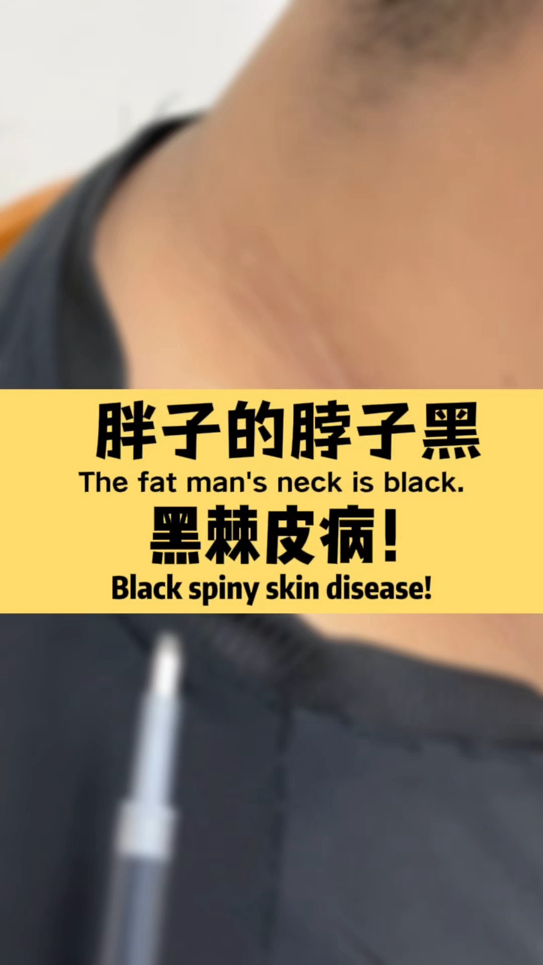胖子的脖子黑,可能是黑棘皮病!