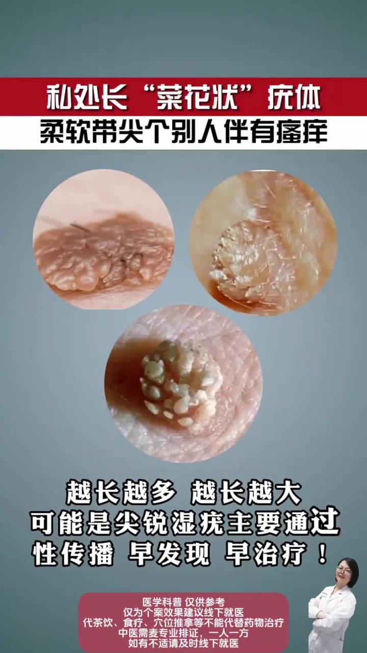 私处长“菜花状”疣体