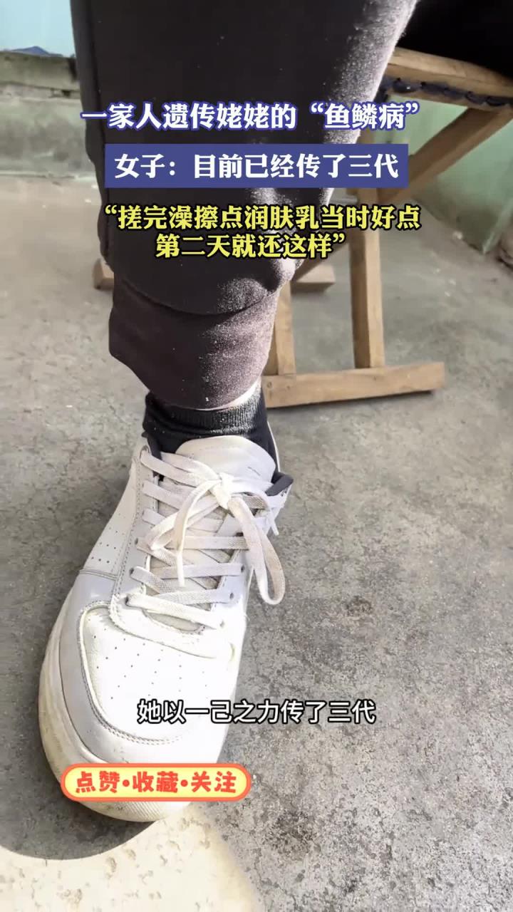 三代人遗传“鱼鳞病”，女子无奈：搓澡润肤仅能短暂缓解