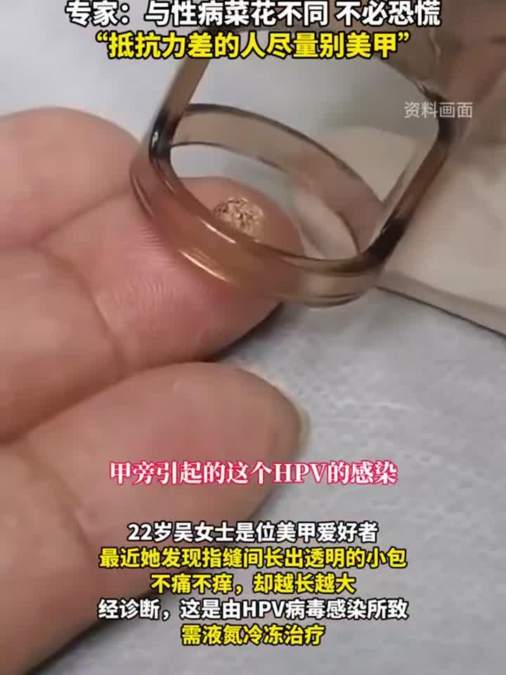 美甲工具藏隐患,22岁女生感染HPV长满菜花疣
