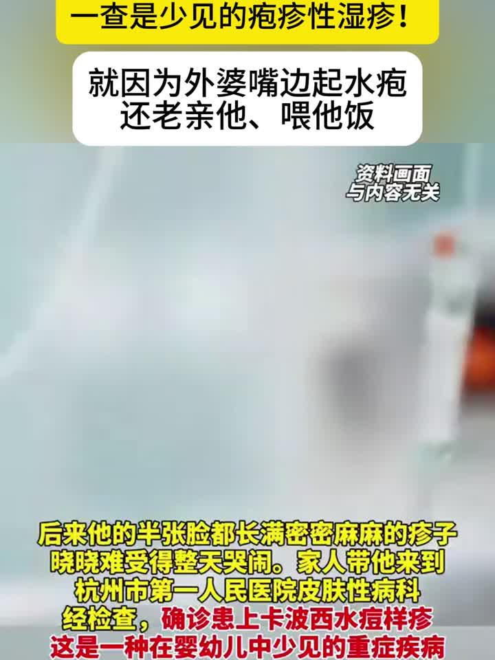 外婆一个吻,宝宝半脸疹,疱疹病毒传染需警惕