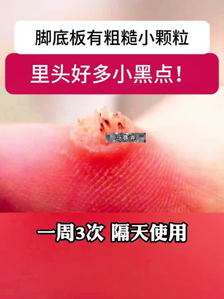 脚底板长小疙瘩,里面有很多小黑点,可别当鸡眼治!这是跖疣