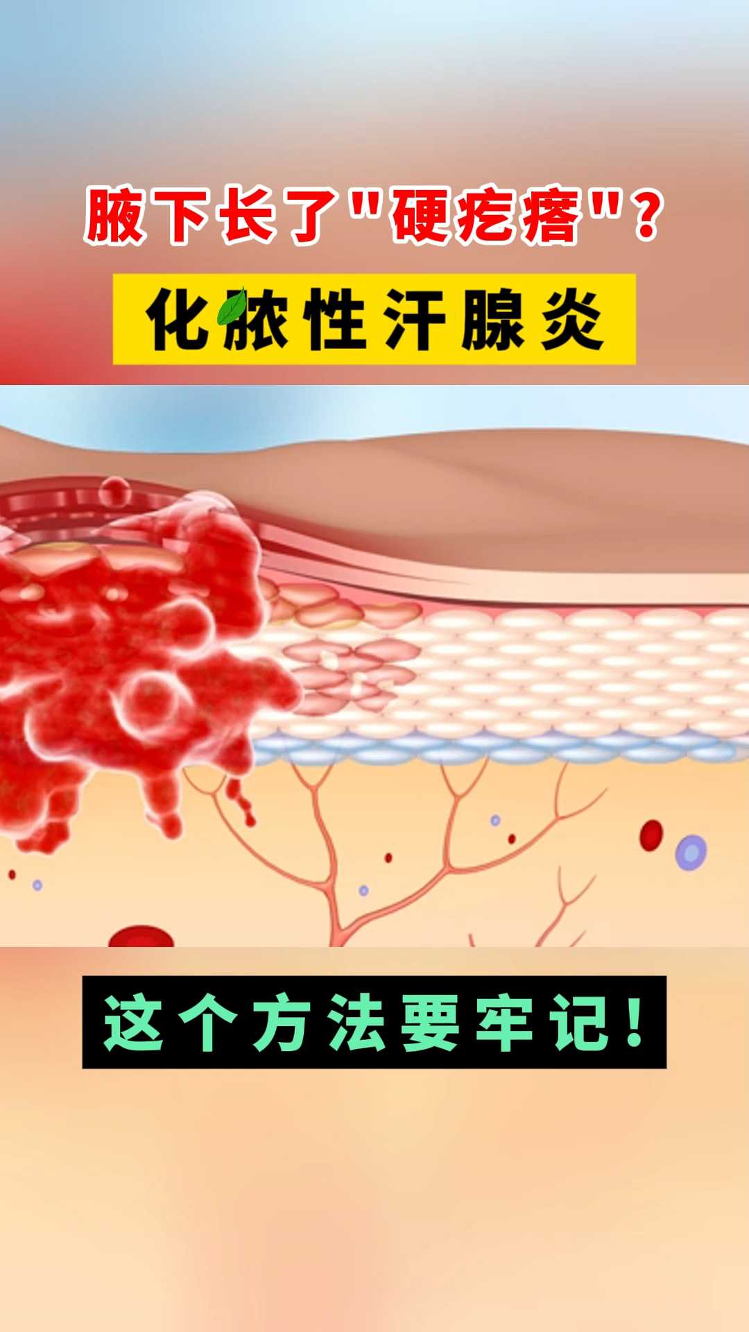 腋下长了硬疙瘩?化脓性汗腺炎,这个方法要牢记!