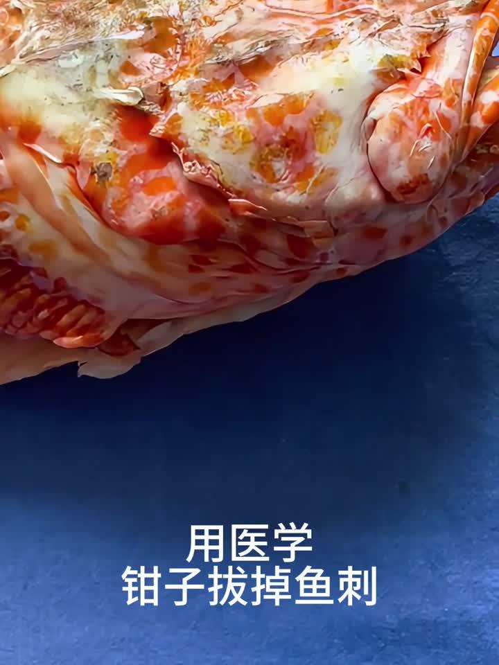 医生巧用专业工具,轻松取出鱼刺全过程