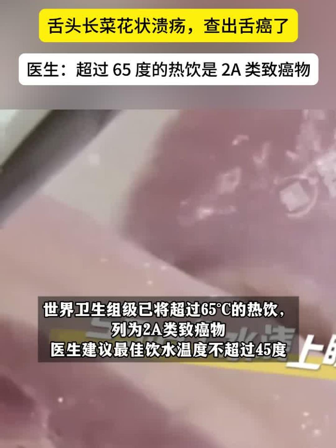滚烫养生20年，46岁男子舌长菜花状肿瘤确诊舌癌