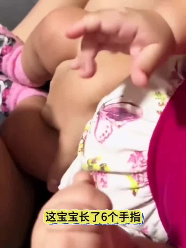宝宝饿第六根手指,会不会影响呀