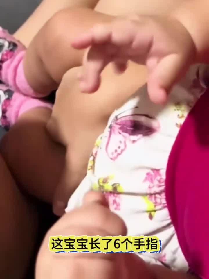 宝宝饿第六根手指,会不会影响呀
