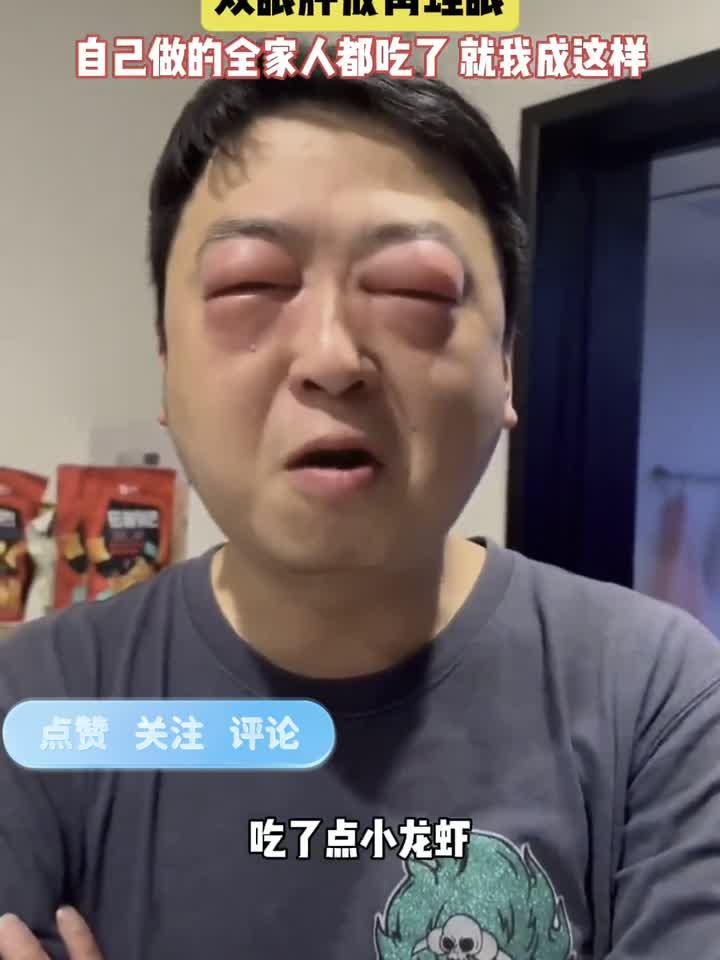 男子吃小龙虾后突发严重过敏，双眼红肿如蛙眼警示食品安全