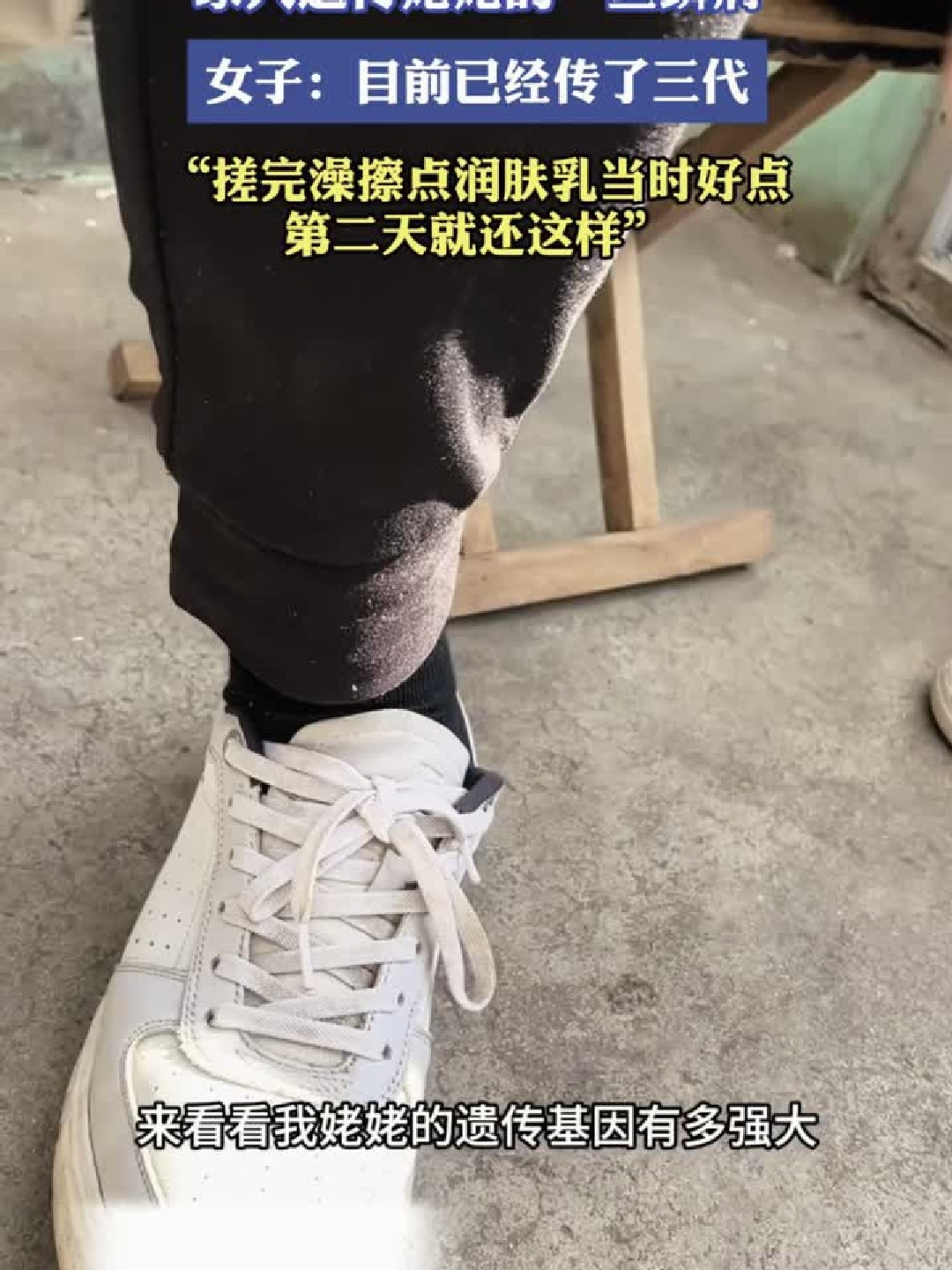 一家人遗传姥姥的“鱼鳞病”，女子：目前已经传了三代，搓完澡擦