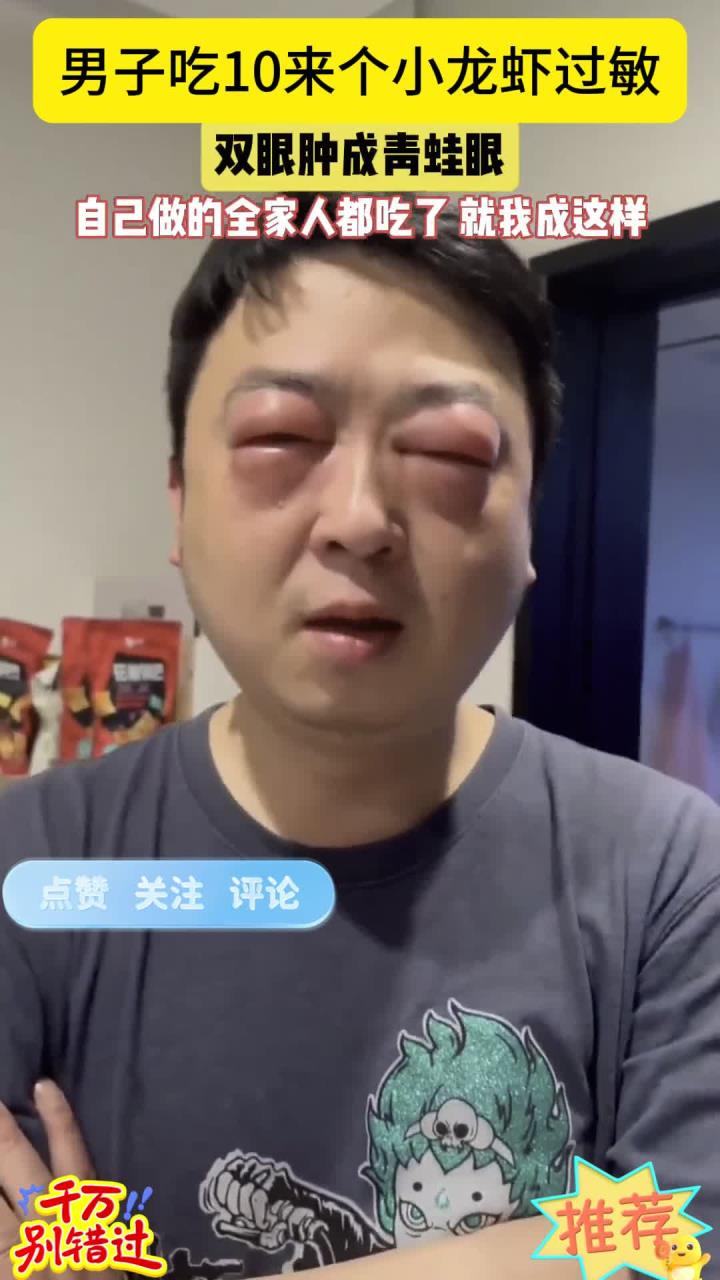 近日,江苏一男子吃过小龙虾后,双眼红肿过敏肿成青蛙眼一样