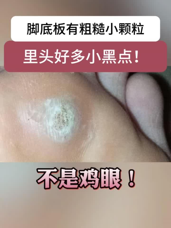 脚底板长小疙瘩,里面有很多小黑点,可别当鸡眼治!这是跖疣