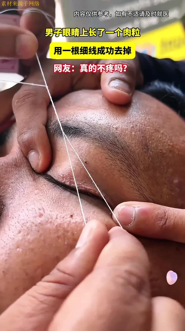 男子眼睛上长了一个肉粒,用一根细线成功去掉,网友:真的不疼吗