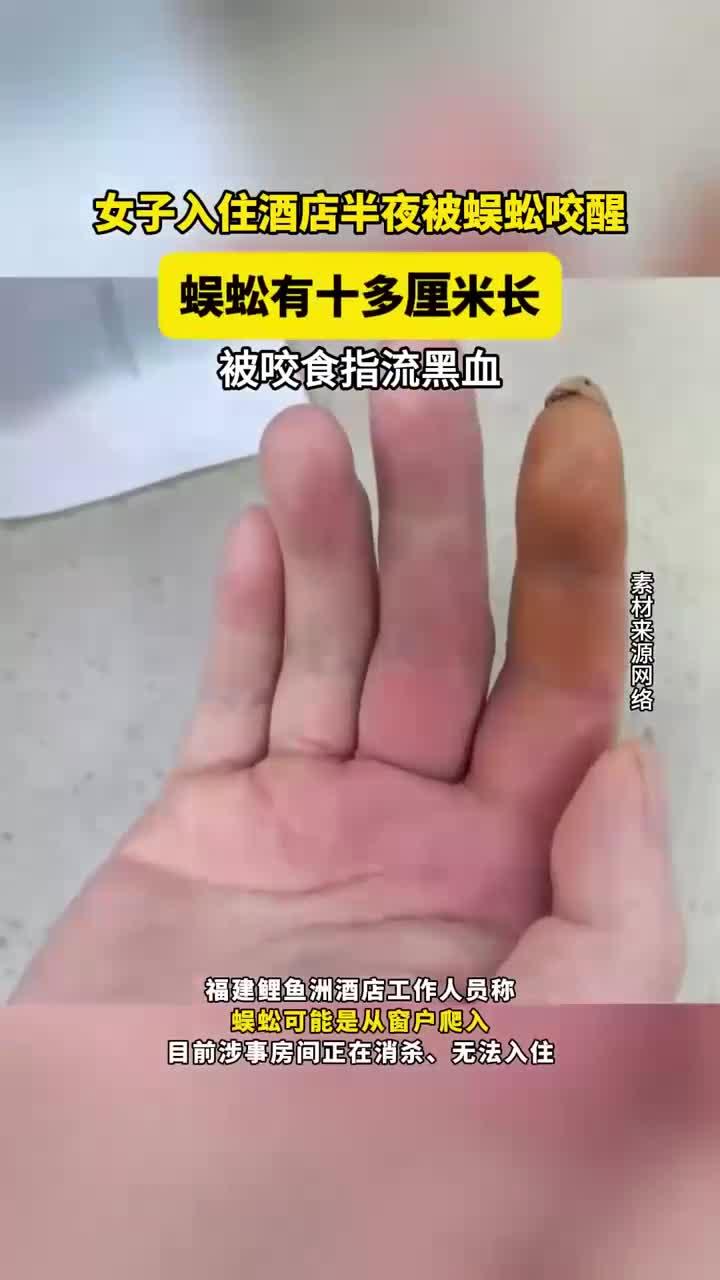 女子入住酒店半夜被蜈蚣咬醒