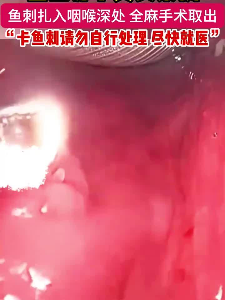 咽喉深刺鱼骨,医生全麻手术取出真实案例