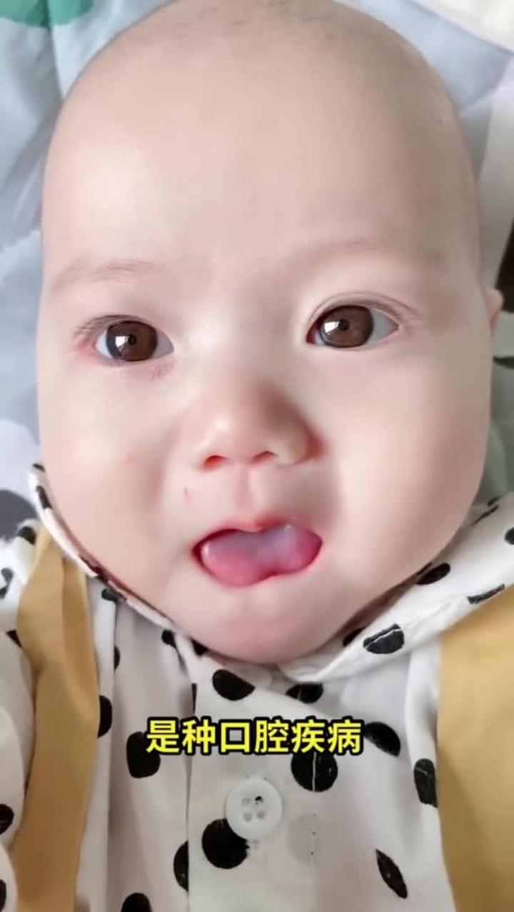宝宝长鹅口疮家长一定要注意宝宝口腔清洁和护理，你家宝宝长过鹅口疮吗？