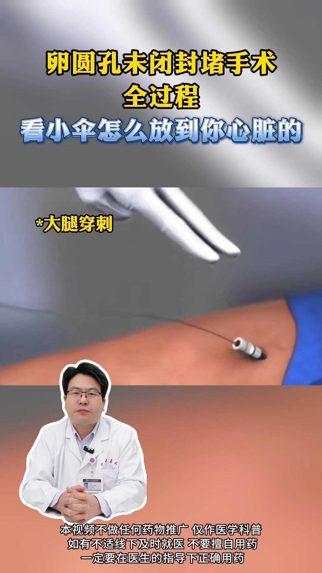 卵圆孔未闭封堵手术全过程看小伞怎么放到你心脏的