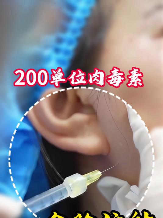 200单位肉毒素如何全脸注射!