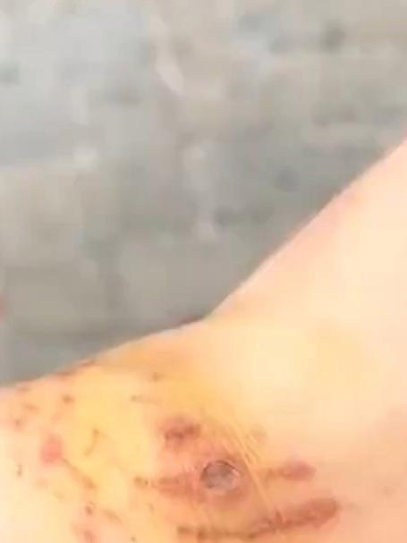 女子生理期在马尔代夫潜水,追鲨鱼过程中被护士鲨咬伤手臂,被提醒:感染了要截肢!