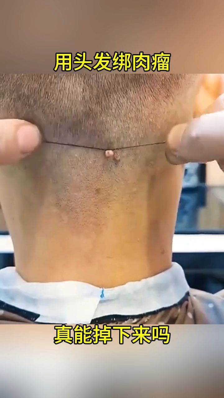 用头发绑肉瘤,真能掉下来吗