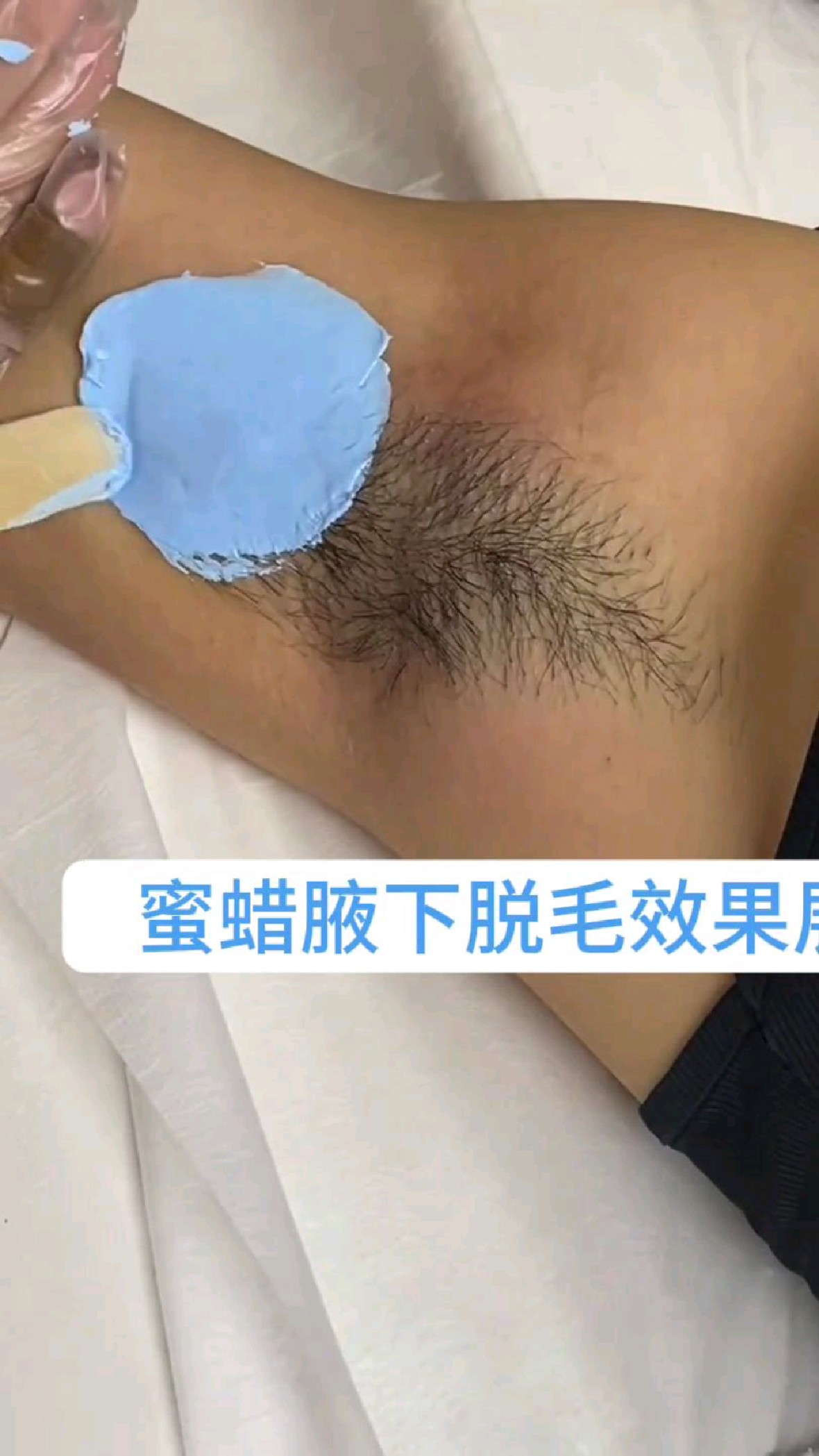 蜜蜡腋下脱毛效果展示