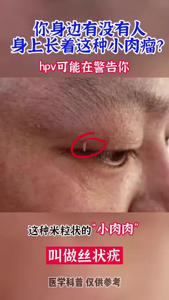 你身边有没有人身上长着这样的小“肉瘤”?当心是HPV在警告你!