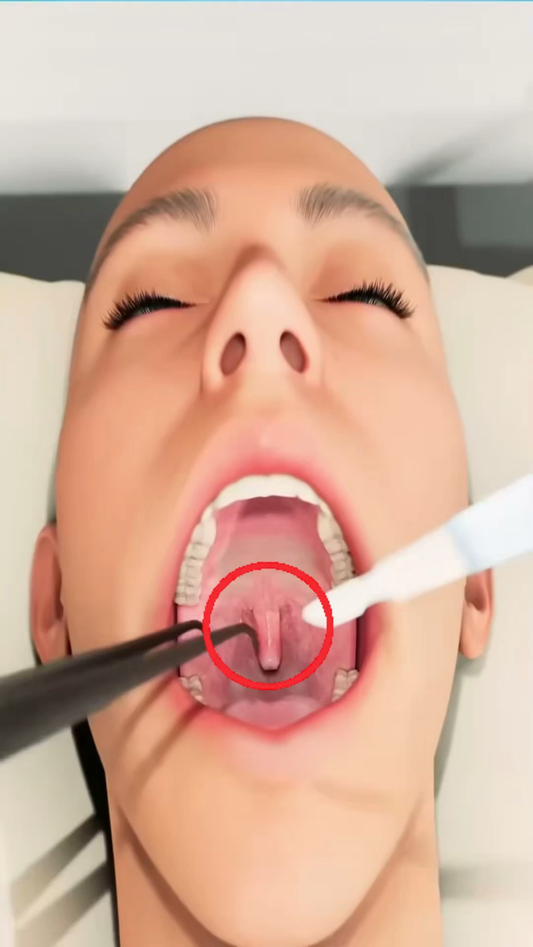 不要轻易割掉你的悬雍垂