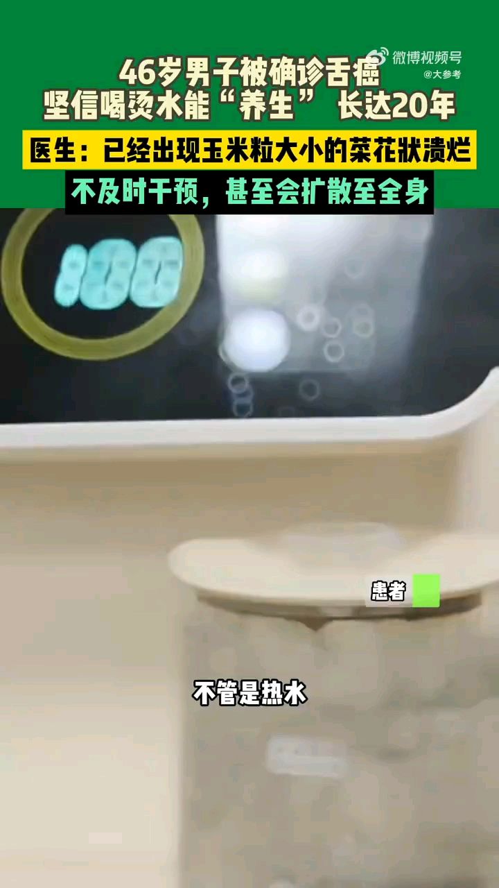 #男子喝热水养生20年查出舌癌#】#男子溃疡久不愈合查出舌癌#
