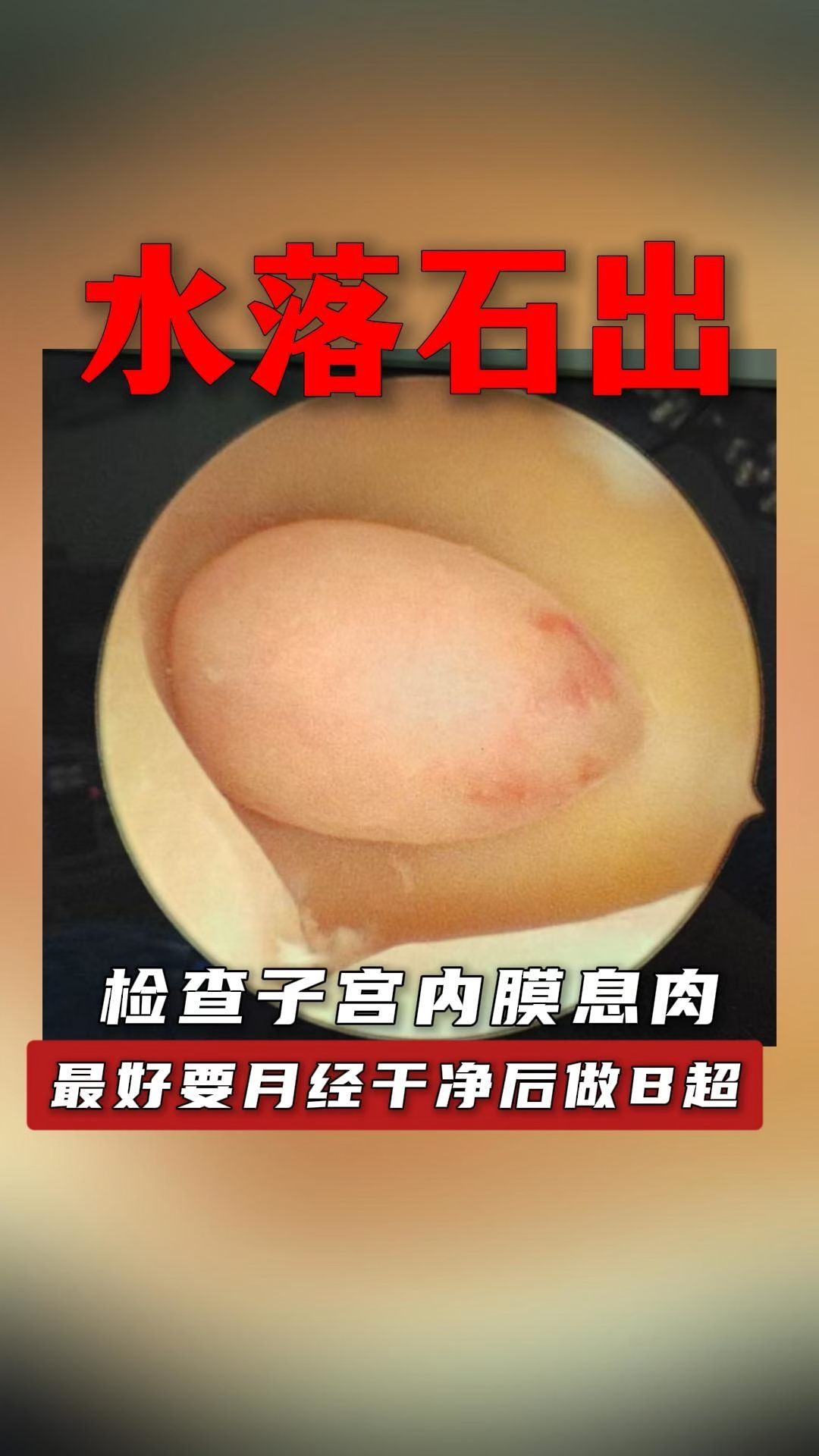 检查子宫内膜息肉最好月经干净后做B超！