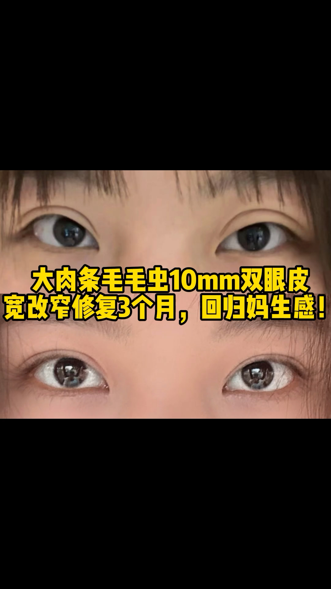 大肉条毛毛虫10mm双眼皮宽改窄修复3个月,回归妈生感!