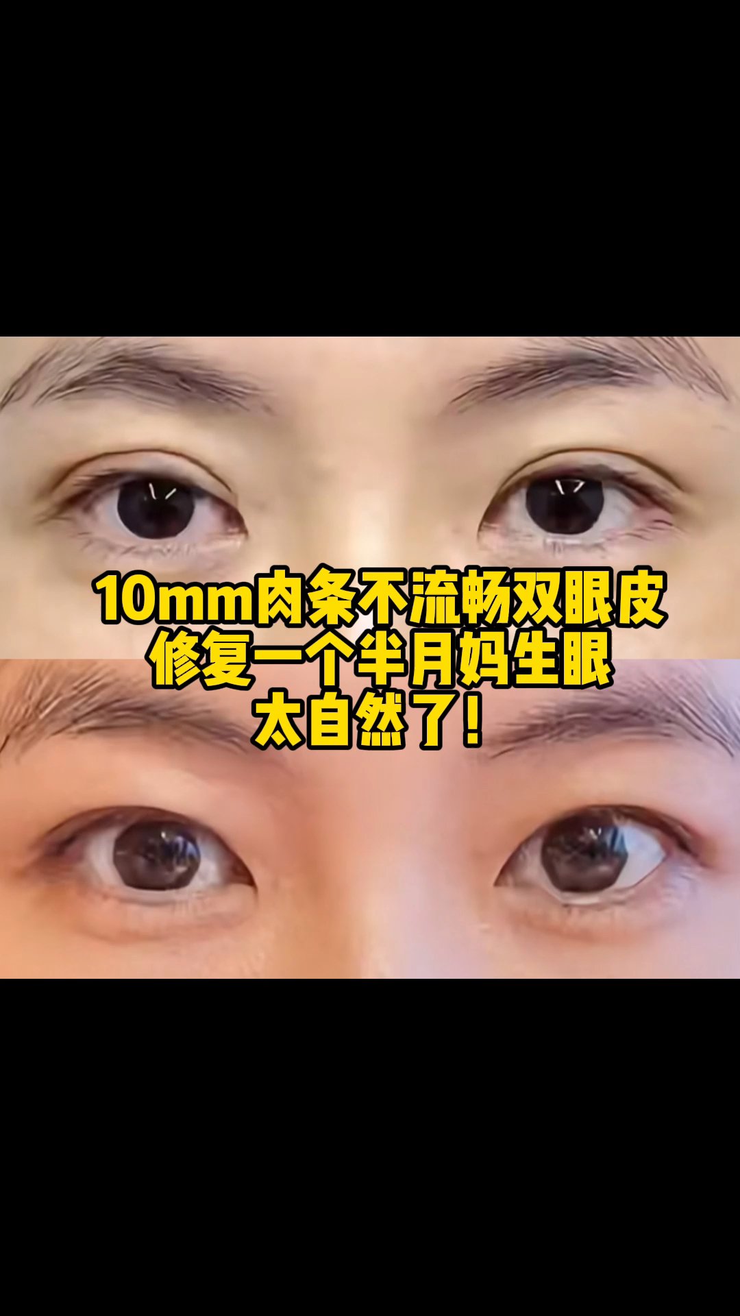 10mm肉条不流畅双眼皮修复妈生眼一个半月,太自然了!