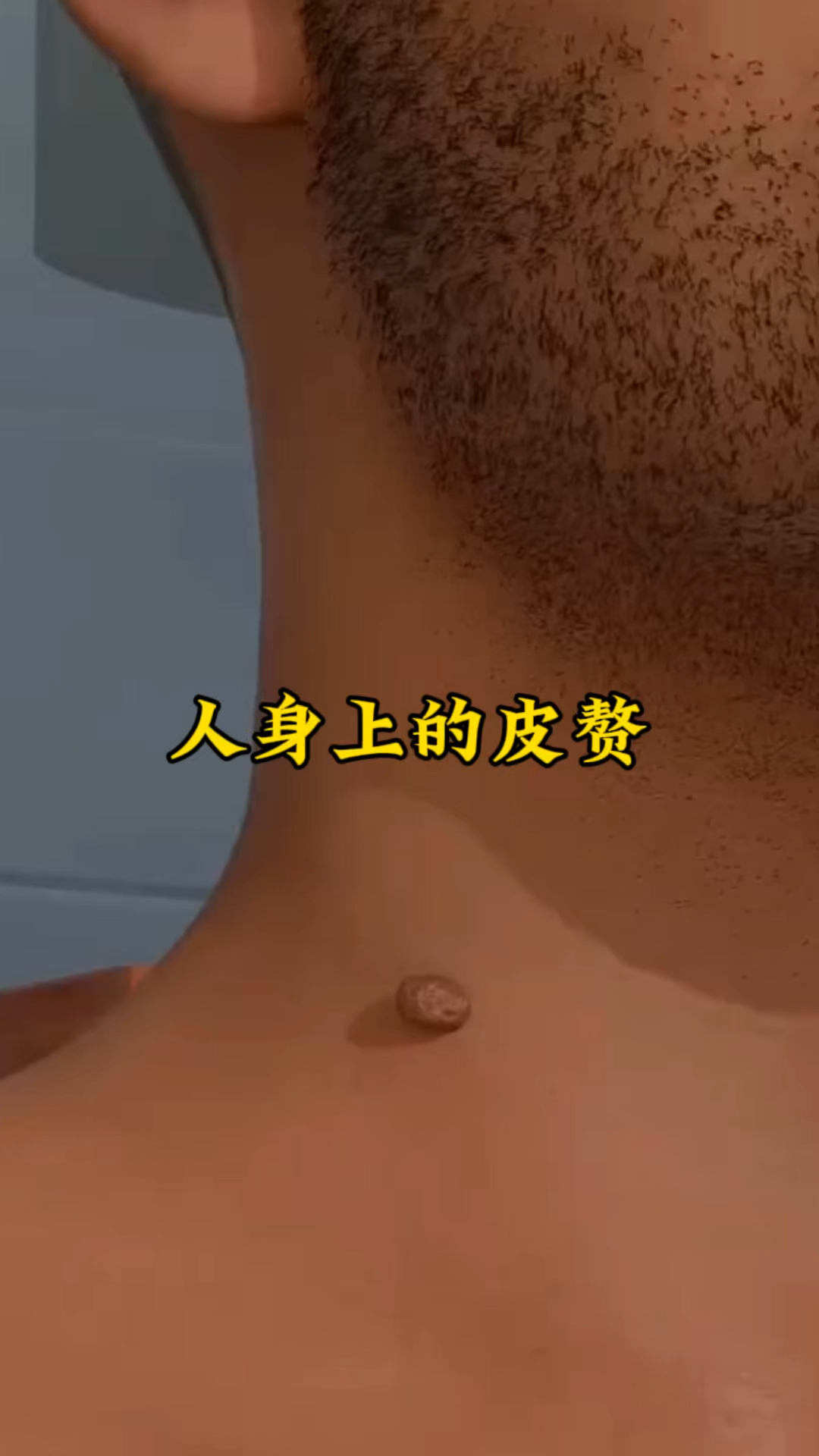人身上的皮赘,千万不能直接扯掉