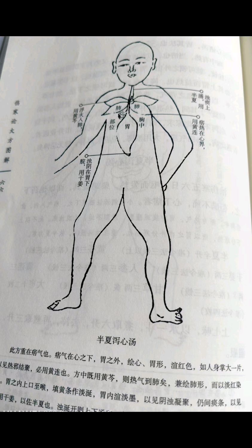 半夏泻心汤治疗胃癌术后化疗后起码呕吐症状。