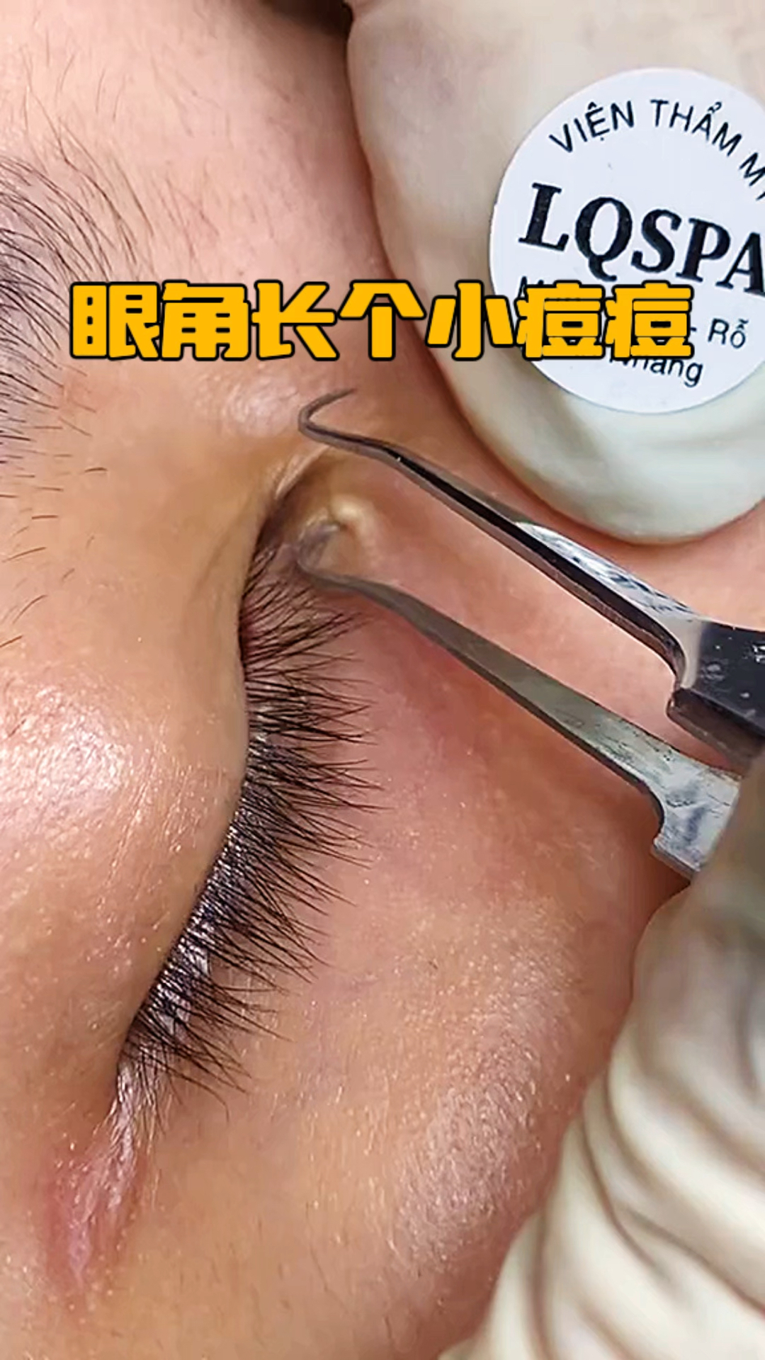 眼角长个小痘痘,我帮你整下去