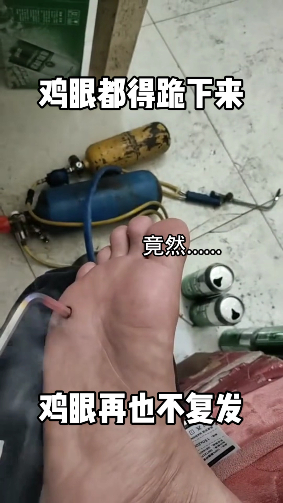 鸡眼再不复发了!这个办法可以啊,鸡眼都得跪下来求你?