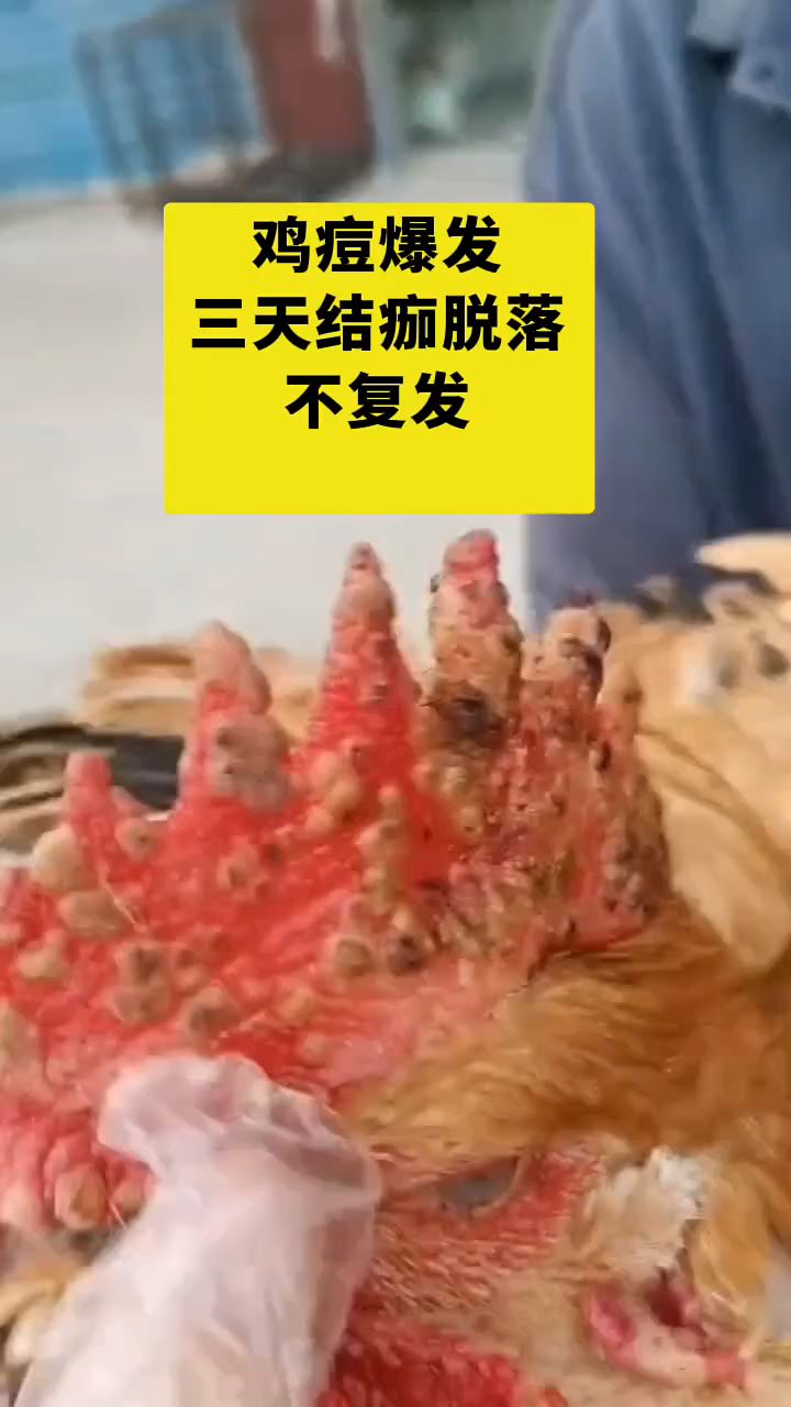鸡痘爆发三天结痂脱落不复发