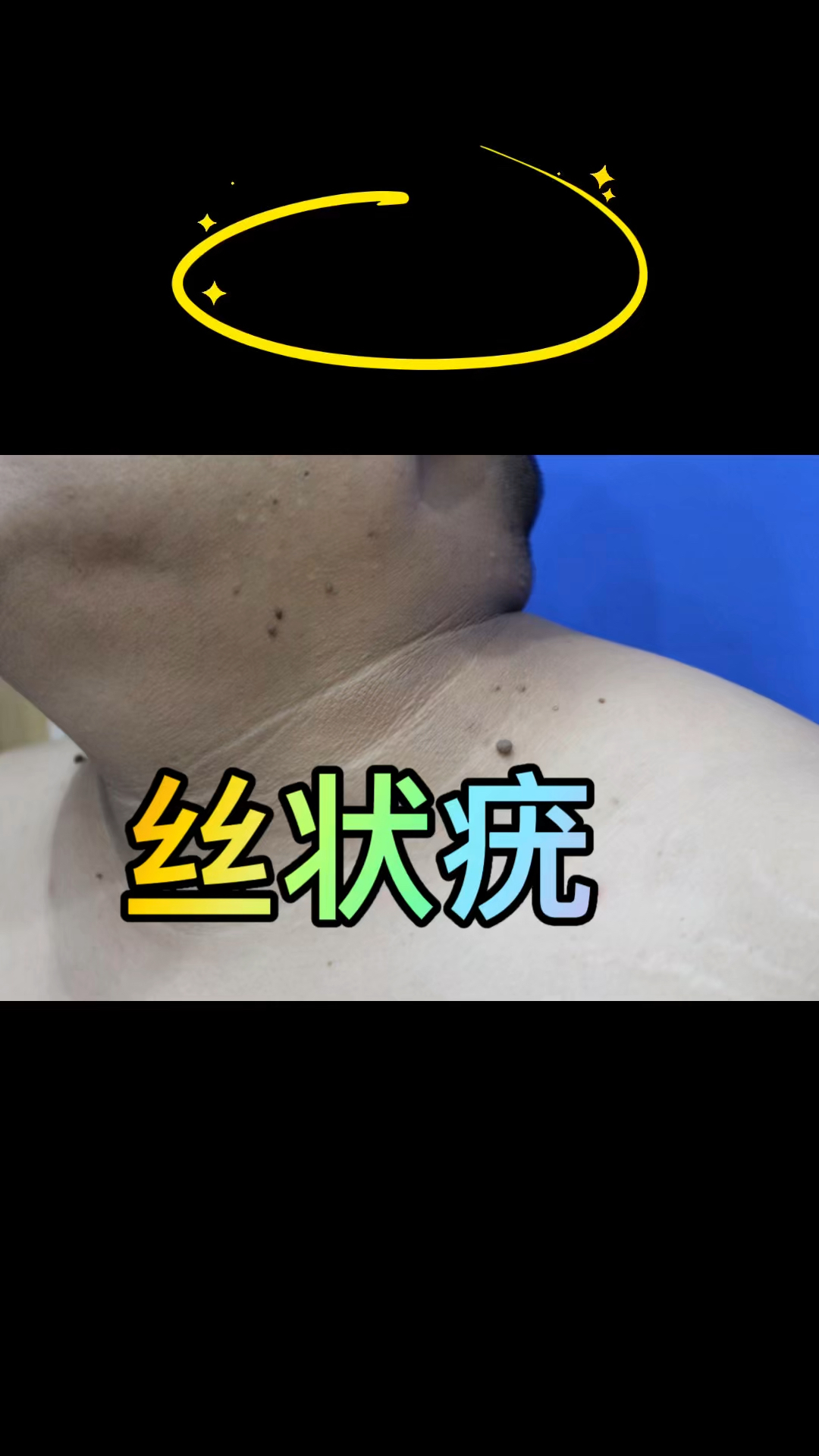 面颈腋窝小肉疙瘩