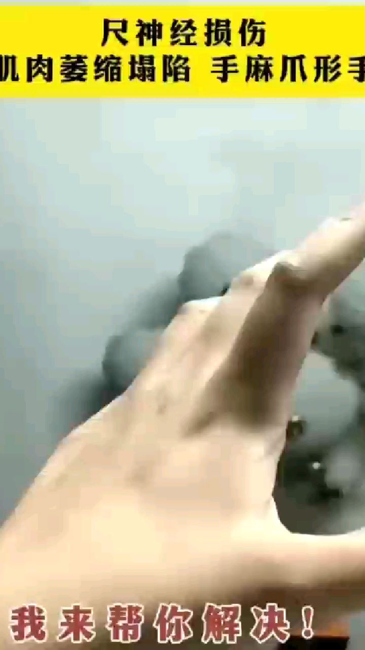 尺神经损伤,肌肉萎缩塌陷手麻爪形手