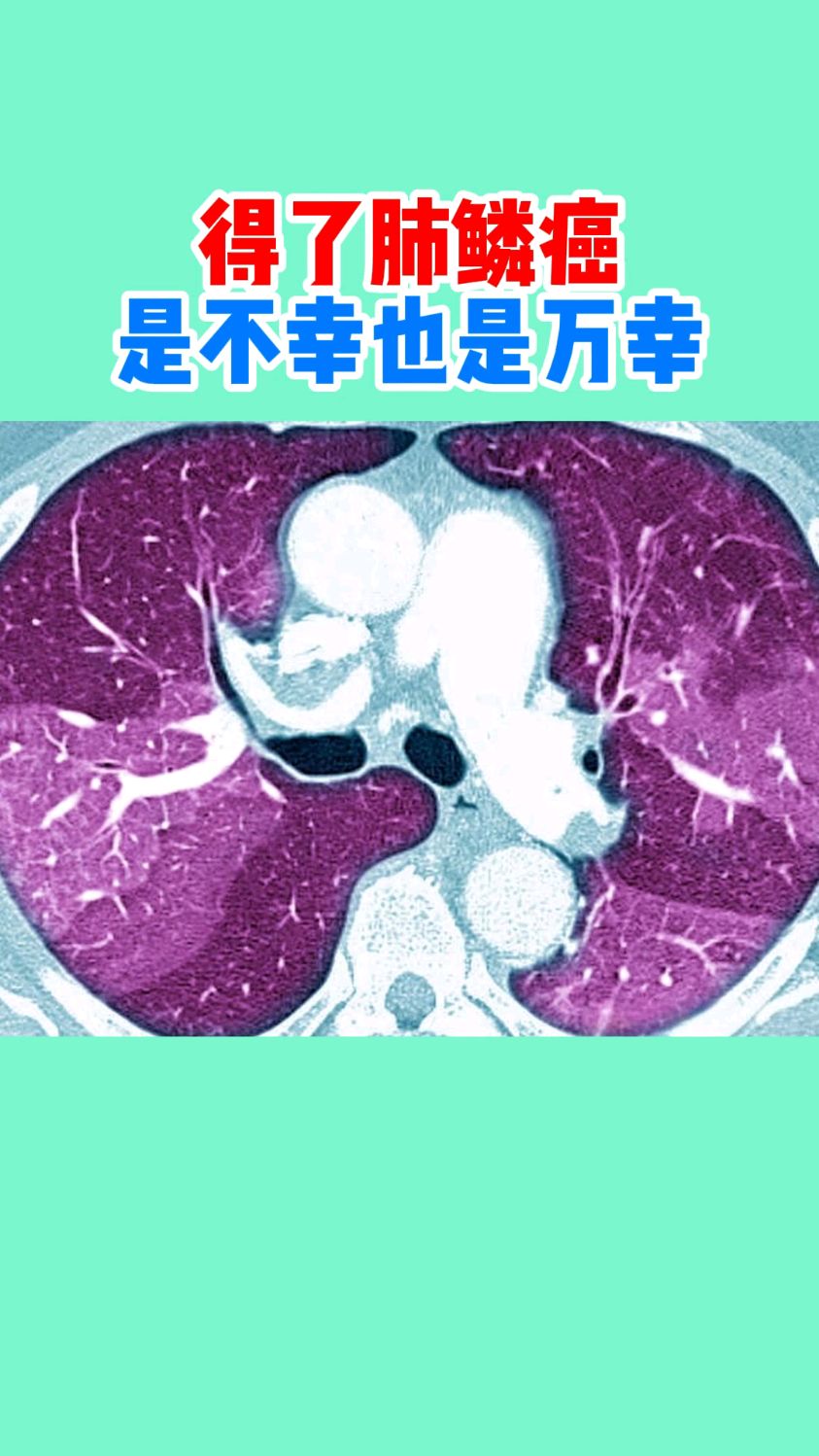 得了肺鳞癌是不幸也是万幸