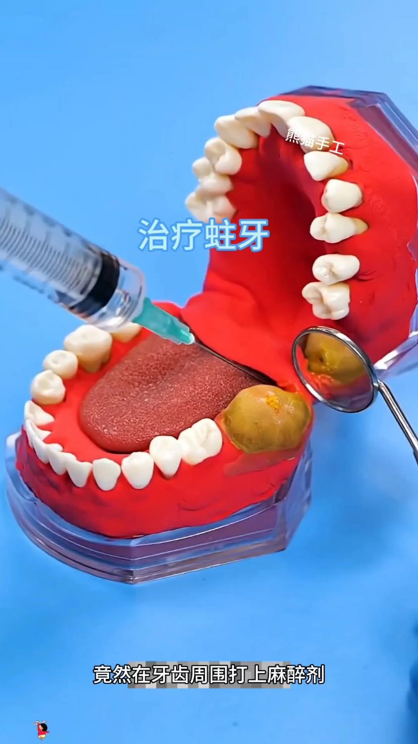 原来蛀牙是这样治疗的，太厉害了