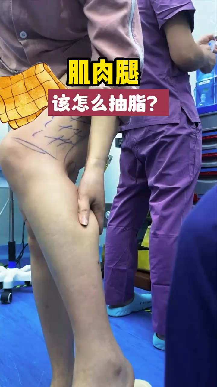 肌肉腿要如何抽脂呢