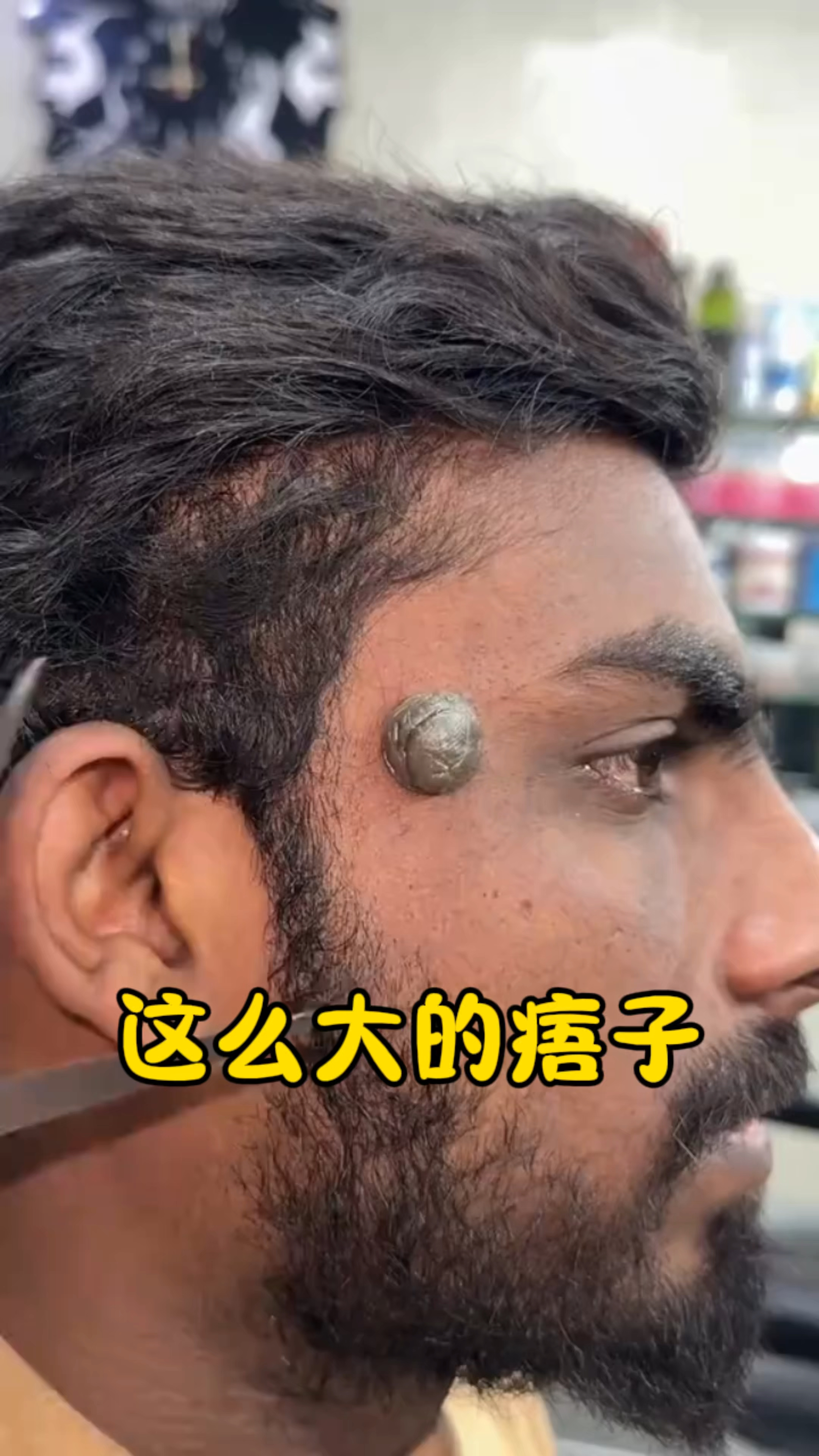 脸上为啥会长这么大的痦子