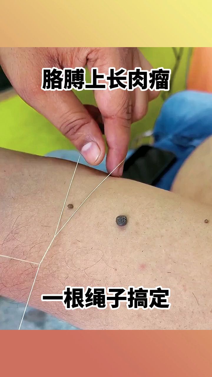 胳膊上长肉瘤，一根绳子搞定！