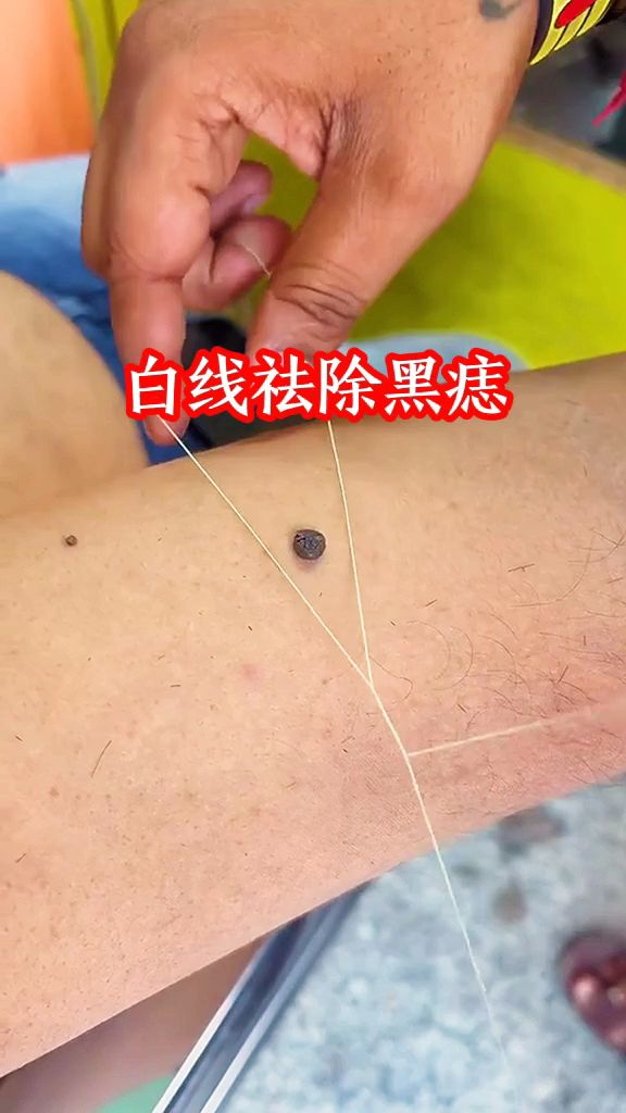 白线祛除肉瘤，没有任何疤痕