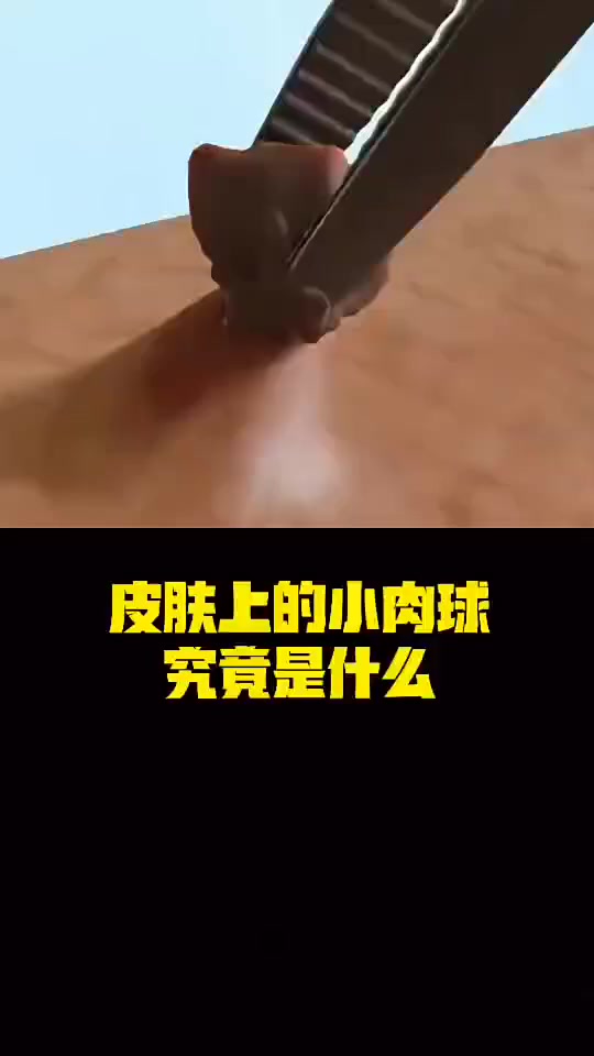 每日科普：们知道皮肤上长的小肉球到底是什么吗？又是如何祛除的