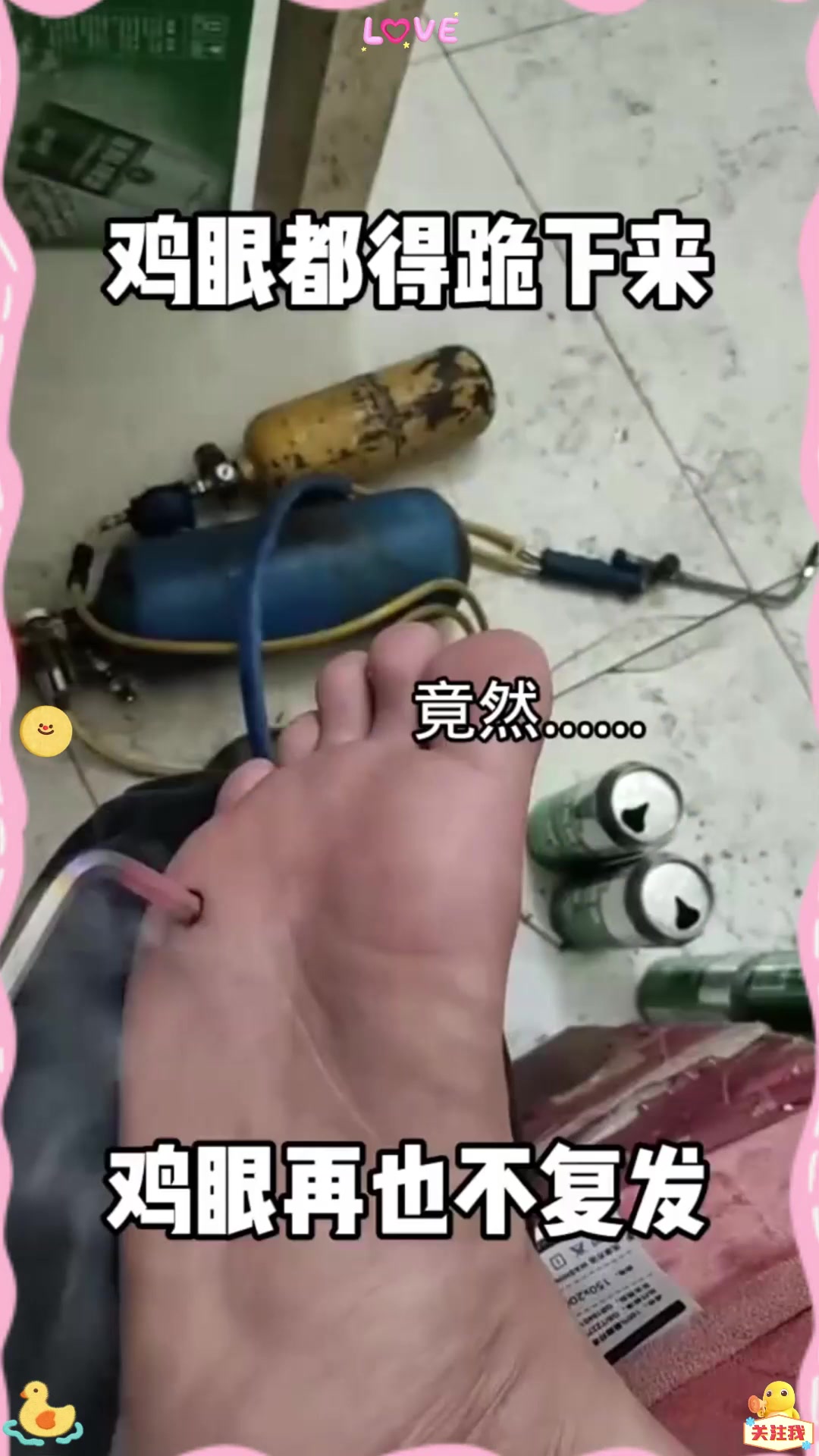 鸡眼再不复发了!这个办法可以啊,鸡眼都得跪下来求你?