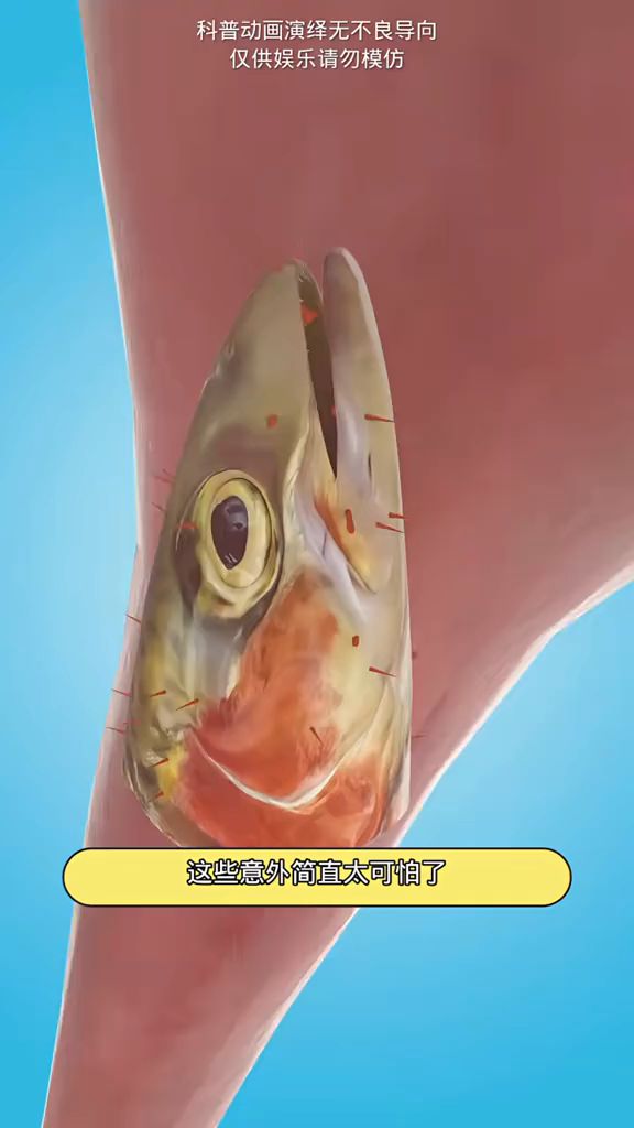 小孩误吞鱼头事件